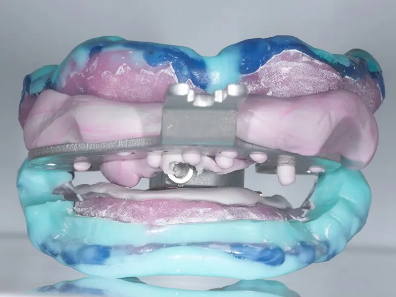 Biofunctional Complete Dentures Made With The Centric Tray And Centrofix Amann Girrbach System – Based On The Patient’s Case