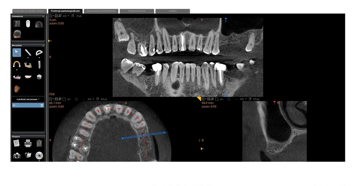 Przypadek implantacji