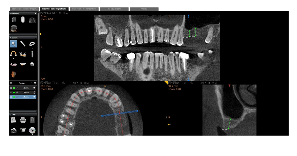 Przypadek implantacji