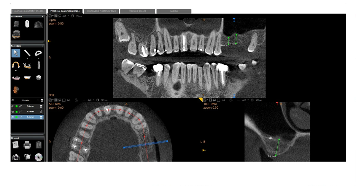 Przypadek implantacji