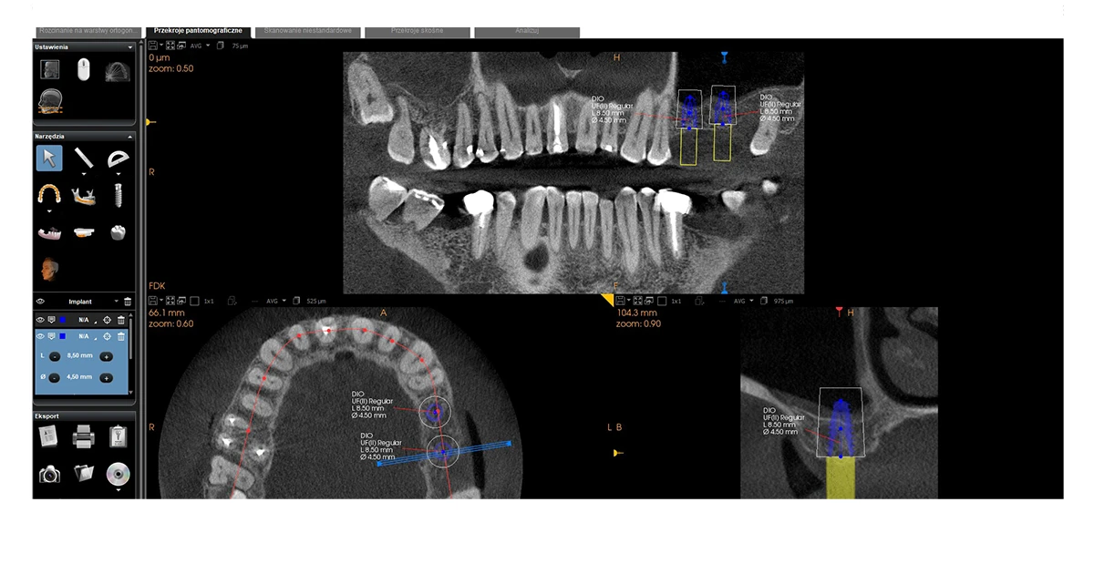 Przypadek implantacji