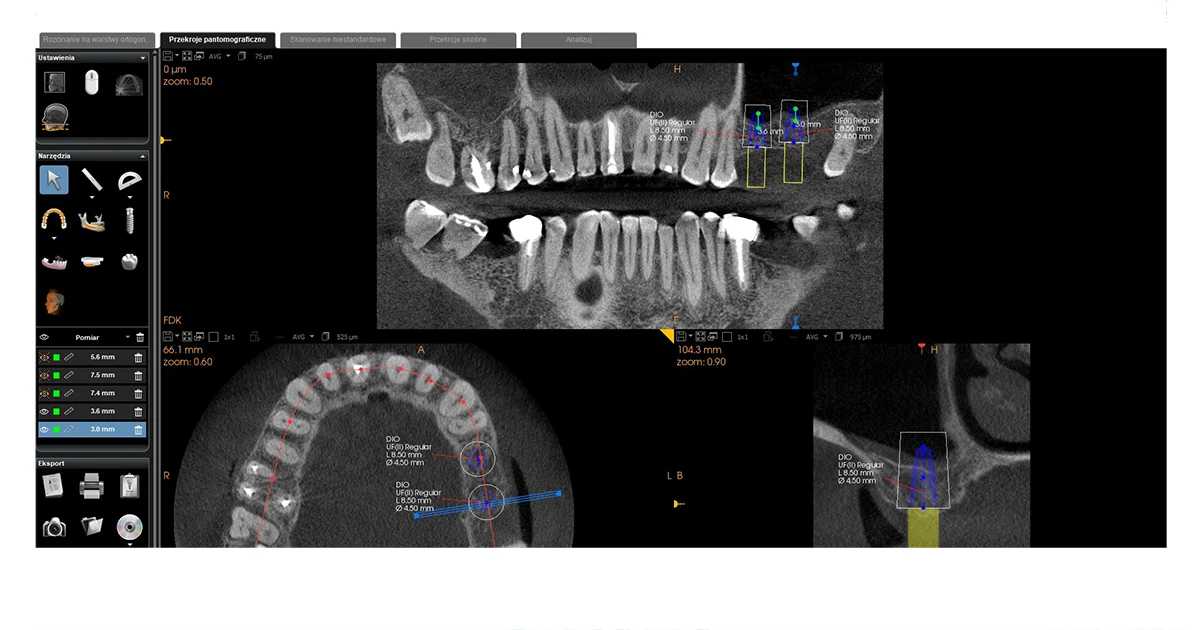 Przypadek implantacji